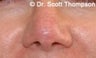 Mohs Reconstruction Surgery