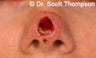 Mohs Reconstruction Surgery