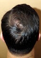 FUE hair transplantation - crown restoration no linear scars
