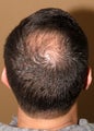 FUE hair transplantation - crown restoration no linear scars