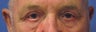 Male Upper eyelid blepharoplasty