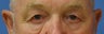 Male Upper eyelid blepharoplasty