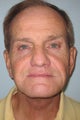 Neck lift in 66 year old man