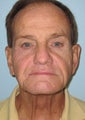 Neck lift in 66 year old man