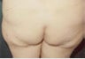 Buttock Augmentation With Fat Transfer