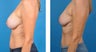 56 Year Old Woman, Breast Implant Removal with Internal Lift