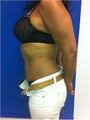 Laser Liposuction