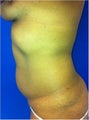 Laser Liposuction