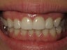 Porcelain Crowns Before & After Photo