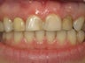 Porcelain Crowns Before & After Photo