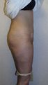 Liposuction (lateral thighs and abdomen)