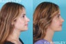 Revision Rhinoplasty