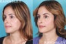 Revision Rhinoplasty