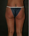Thigh and Buttock Lift