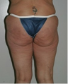 Thigh and Buttock Lift
