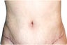 Smart Lipo with Tummy Tuck