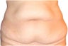 Smart Lipo with Tummy Tuck