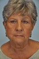 Upper eye lid skin causing vision problems