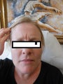 Botox