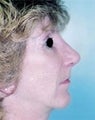 Female patient who underwent nose surgery with a chin implant