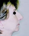 Female patient who underwent nose surgery with a chin implant