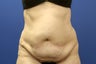 Tummy Tuck