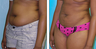 Liposuction Before & After