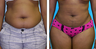 Liposuction Before & After