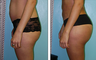 Brazilian Butt Lift Before & After