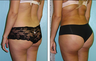 Brazilian Butt Lift Before & After
