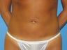 40 yr old woman for Liposuction of Abdomen