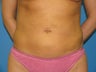 40 yr old woman for Liposuction of Abdomen