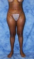 Brazilian Butt Lift and creating curves