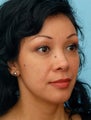 Restylane Treatment to the Eyes and Cheeks