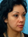 Restylane Treatment to the Eyes and Cheeks