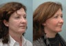 Facial Reconstructive Surgery
