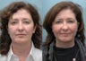 Facial Reconstructive Surgery