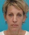 Browlift, upper blepharoplasty, lower blepharoplasty