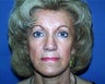 Face/neck lift