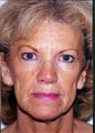 Face/neck lift