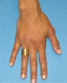 Hand Rejuvenation