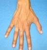 Hand Rejuvenation