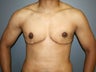 Gender Reassignment with Bilateral Mastectomies