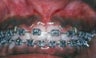 Gum Depigmentation Before and After
