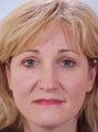 Upper and Lower Eyelid Surgery with a Browlift