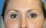 Browlift, Skin Pinch, and Fat Transfer