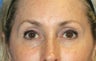 Browlift, Skin Pinch, and Fat Transfer