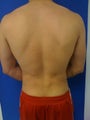 Laser Lipo