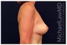Breast Lift