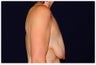 Breast Lift